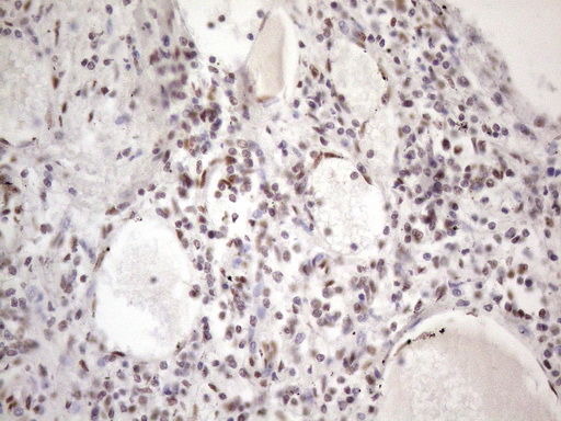 TP53BP1 / 53BP1 Antibody - Immunohistochemical staining of paraffin-embedded Human lymph node tissue within the normal limits using anti-TP53BP1 mouse monoclonal antibody. (Heat-induced epitope retrieval by 1 mM EDTA in 10mM Tris, pH8.5, 120C for 3min. (1:150)