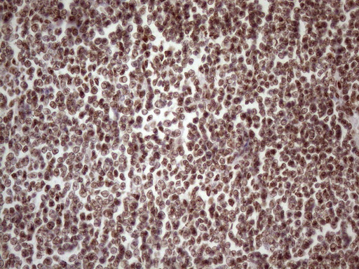 TP53BP1 / 53BP1 Antibody - Immunohistochemical staining of paraffin-embedded Human lymphoma tissue using anti-TP53BP1 mouse monoclonal antibody. (Heat-induced epitope retrieval by 1 mM EDTA in 10mM Tris, pH8.5, 120C for 3min. (1:150)