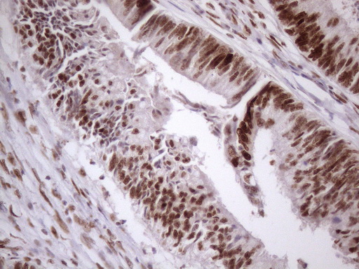 TP53BP1 / 53BP1 Antibody - Immunohistochemical staining of paraffin-embedded Adenocarcinoma of Human colon tissue using anti-TP53BP1 mouse monoclonal antibody. (Heat-induced epitope retrieval by 1 mM EDTA in 10mM Tris, pH8.5, 120C for 3min. (1:150)