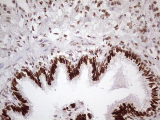 TP53BP1 / 53BP1 Antibody - Immunohistochemical staining of paraffin-embedded Human lung tissue within the normal limits using anti-TP53BP1 mouse monoclonal antibody. (Heat-induced epitope retrieval by 1 mM EDTA in 10mM Tris, pH8.5, 120C for 3min. (1:150)