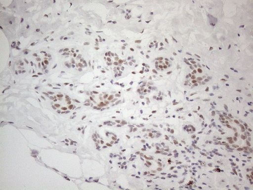 TP53BP1 / 53BP1 Antibody - Immunohistochemical staining of paraffin-embedded Human breast tissue within the normal limits using anti-TP53BP1 mouse monoclonal antibody. (Heat-induced epitope retrieval by 1mM EDTA in 10mM Tris buffer. (pH8.5) at 120°C for 3 min. (1:150)