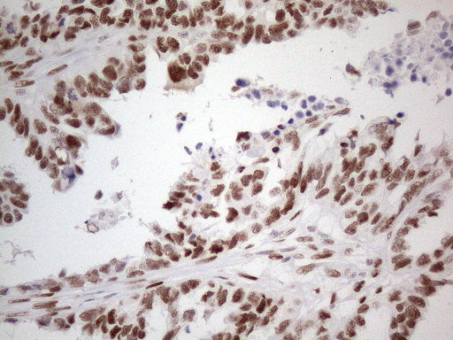 TP53BP1 / 53BP1 Antibody - Immunohistochemical staining of paraffin-embedded Adenocarcinoma of Human ovary tissue using anti-TP53BP1 mouse monoclonal antibody. (Heat-induced epitope retrieval by 1mM EDTA in 10mM Tris buffer. (pH8.5) at 120°C for 3 min. (1:150)
