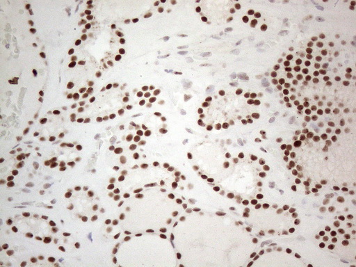 TP53BP1 / 53BP1 Antibody - Immunohistochemical staining of paraffin-embedded Human thyroid tissue within the normal limits using anti-TP53BP1 mouse monoclonal antibody. (Heat-induced epitope retrieval by 1mM EDTA in 10mM Tris buffer. (pH8.5) at 120°C for 3 min. (1:150)
