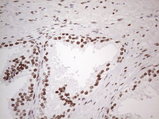 TP53BP1 / 53BP1 Antibody - Immunohistochemical staining of paraffin-embedded Human prostate tissue within the normal limits using anti-TP53BP1 mouse monoclonal antibody. (Heat-induced epitope retrieval by 1mM EDTA in 10mM Tris buffer. (pH8.5) at 120°C for 3 min. (1:150)