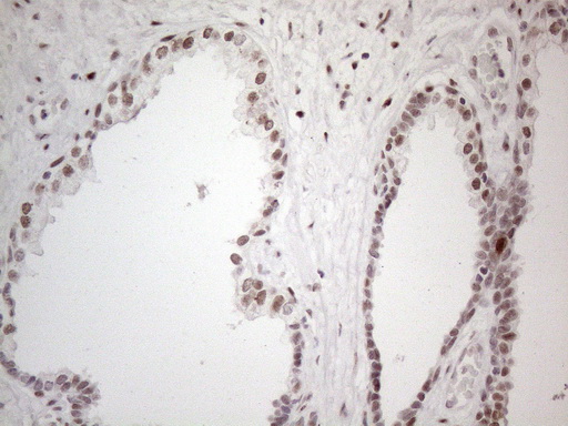 TP53BP1 / 53BP1 Antibody - Immunohistochemical staining of paraffin-embedded Carcinoma of Human prostate tissue using anti-TP53BP1 mouse monoclonal antibody. (Heat-induced epitope retrieval by 1mM EDTA in 10mM Tris buffer. (pH8.5) at 120°C for 3 min. (1:150)