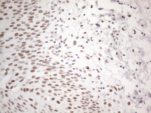 TP53BP1 / 53BP1 Antibody - Immunohistochemical staining of paraffin-embedded Human bladder tissue within the normal limits using anti-TP53BP1 mouse monoclonal antibody. (Heat-induced epitope retrieval by 1mM EDTA in 10mM Tris buffer. (pH8.5) at 120°C for 3 min. (1:150)
