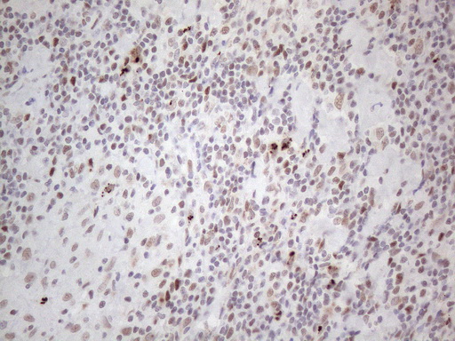 TP53BP1 / 53BP1 Antibody - Immunohistochemical staining of paraffin-embedded Human lymph node tissue within the normal limits using anti-TP53BP1 mouse monoclonal antibody. (Heat-induced epitope retrieval by 1mM EDTA in 10mM Tris buffer. (pH8.5) at 120°C for 3 min. (1:150)