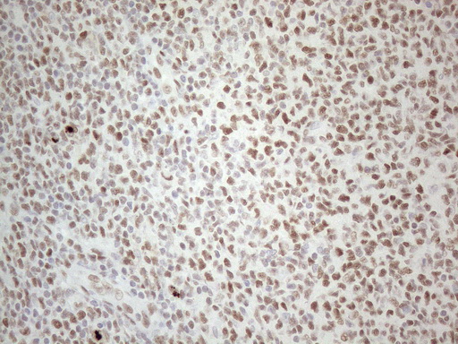 TP53BP1 / 53BP1 Antibody - Immunohistochemical staining of paraffin-embedded Human lymphoma tissue using anti-TP53BP1 mouse monoclonal antibody. (Heat-induced epitope retrieval by 1mM EDTA in 10mM Tris buffer. (pH8.5) at 120°C for 3 min. (1:150)
