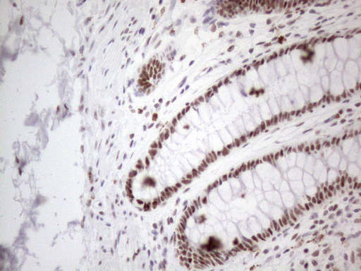 TP53BP1 / 53BP1 Antibody - Immunohistochemical staining of paraffin-embedded Human colon tissue within the normal limits using anti-TP53BP1 mouse monoclonal antibody. (Heat-induced epitope retrieval by 1mM EDTA in 10mM Tris buffer. (pH8.5) at 120°C for 3 min. (1:150)