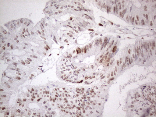 TP53BP1 / 53BP1 Antibody - Immunohistochemical staining of paraffin-embedded Adenocarcinoma of Human colon tissue using anti-TP53BP1 mouse monoclonal antibody. (Heat-induced epitope retrieval by 1mM EDTA in 10mM Tris buffer. (pH8.5) at 120°C for 3 min. (1:150)