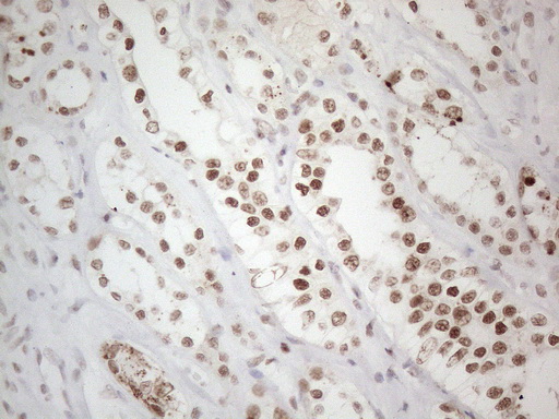 TP53BP1 / 53BP1 Antibody - Immunohistochemical staining of paraffin-embedded Human Kidney tissue within the normal limits using anti-TP53BP1 mouse monoclonal antibody. (Heat-induced epitope retrieval by 1mM EDTA in 10mM Tris buffer. (pH8.5) at 120°C for 3 min. (1:150)