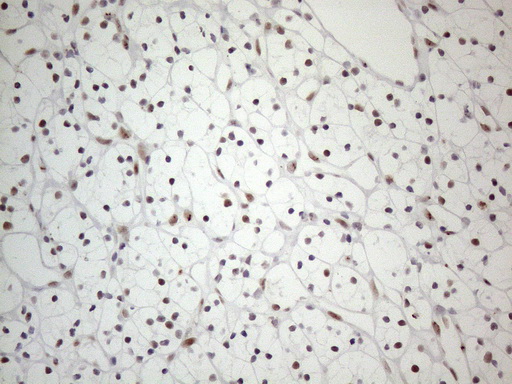 TP53BP1 / 53BP1 Antibody - Immunohistochemical staining of paraffin-embedded Carcinoma of Human kidney tissue using anti-TP53BP1 mouse monoclonal antibody. (Heat-induced epitope retrieval by 1mM EDTA in 10mM Tris buffer. (pH8.5) at 120°C for 3 min. (1:150)