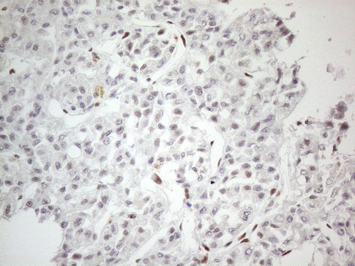 TP53BP1 / 53BP1 Antibody - Immunohistochemical staining of paraffin-embedded Human liver tissue within the normal limits using anti-TP53BP1 mouse monoclonal antibody. (Heat-induced epitope retrieval by 1mM EDTA in 10mM Tris buffer. (pH8.5) at 120°C for 3 min. (1:150)