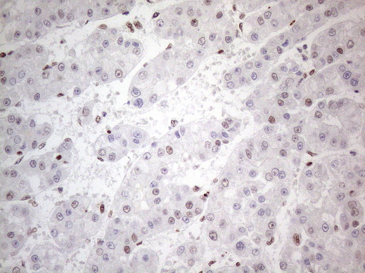 TP53BP1 / 53BP1 Antibody - Immunohistochemical staining of paraffin-embedded Carcinoma of Human liver tissue using anti-TP53BP1 mouse monoclonal antibody. (Heat-induced epitope retrieval by 1mM EDTA in 10mM Tris buffer. (pH8.5) at 120°C for 3 min. (1:150)
