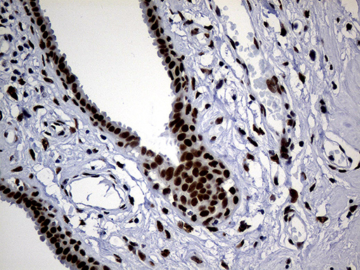 TP53BP1 / 53BP1 Antibody - Immunohistochemical staining of paraffin-embedded Human breast tissue within the normal limits using anti-TP53BP1 mouse monoclonal antibody. (Heat-induced epitope retrieval by 1mM EDTA in 10mM Tris buffer. (pH8.5) at 120°C for 3 min. (1:2000)