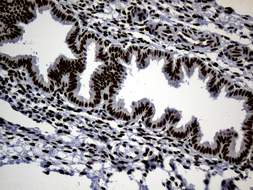 TP53BP1 / 53BP1 Antibody - Immunohistochemical staining of paraffin-embedded Human endometrium tissue within the normal limits using anti-TP53BP1 mouse monoclonal antibody. (Heat-induced epitope retrieval by 1mM EDTA in 10mM Tris buffer. (pH8.5) at 120°C for 3 min. (1:2000)