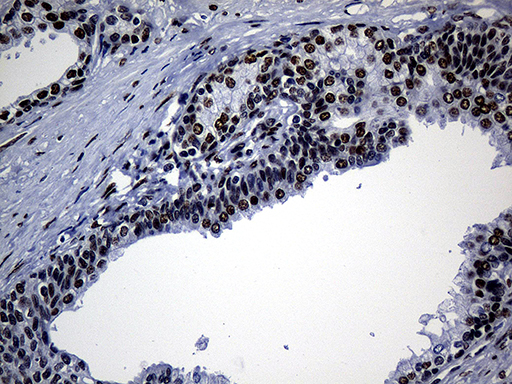 TP53BP1 / 53BP1 Antibody - Immunohistochemical staining of paraffin-embedded Human prostate tissue within the normal limits using anti-TP53BP1 mouse monoclonal antibody. (Heat-induced epitope retrieval by 1mM EDTA in 10mM Tris buffer. (pH8.5) at 120°C for 3 min. (1:2000)