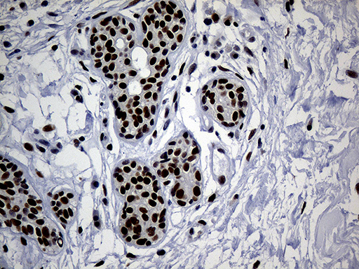 TP53BP1 / 53BP1 Antibody - Immunohistochemical staining of paraffin-embedded Adenocarcinoma of Human breast tissue tissue using anti-TP53BP1 mouse monoclonal antibody. (Heat-induced epitope retrieval by 1mM EDTA in 10mM Tris buffer. (pH8.5) at 120°C for 3 min. (1:2000)