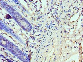 TP53BP1 / 53BP1 Antibody - Immunohistochemistry of paraffin-embedded human rectal cancer using antibody at 1:100 dilution.