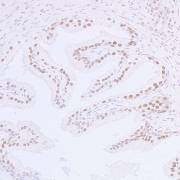 TP53BP1 / 53BP1 Antibody - Detection of human 53BP1 by Immunohistochemistry. Sample: FFPE sections of human prostate carcinoma. Antibody: Affinity purified rabbit anti-53BP1 used at a dilution of 1:5,000 (0.2 µg/ml). Detection: DAB.