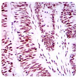 TP53BP1 / 53BP1 Antibody - Immunohistochemistry: 53BP1 Antibody (6B3E10) - Immunohistochemical analysis of paraffin-embedded colon cancer tissues using TP53BP1 mouse mAb with DAB staining.