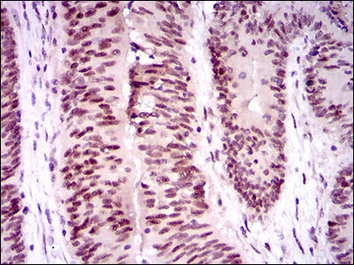 TP53BP1 / 53BP1 Antibody - IHC of paraffin-embedded colon cancer tissues using TP53BP1 mouse monoclonal antibody with DAB staining.