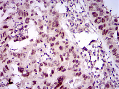 TP53BP1 / 53BP1 Antibody - IHC of paraffin-embedded endometrial cancer tissues using TP53BP1 mouse monoclonal antibody with DAB staining.