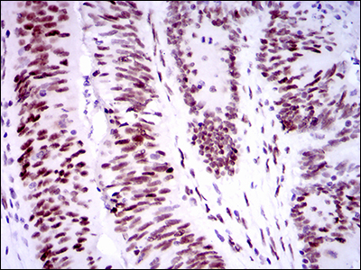 TP53BP1 / 53BP1 Antibody - IHC of paraffin-embedded colon cancer tissues using TP53BP1 mouse monoclonal antibody with DAB staining.