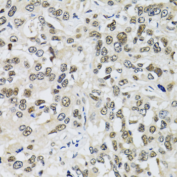 TP53BP1 / 53BP1 Antibody - Immunohistochemistry of paraffin-embedded human liver cancer tissue.