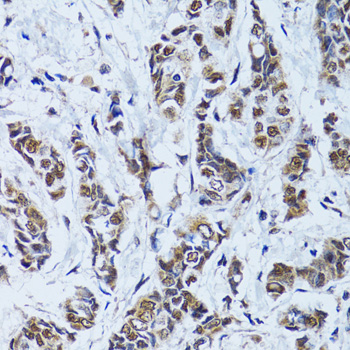 TP53BP1 / 53BP1 Antibody - Immunohistochemistry of paraffin-embedded human breast cancer tissue.