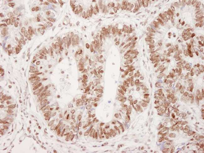 TP53BP1 / 53BP1 Antibody - Detection of Human Phospho-53BP1 (Ser 25) by Immunohistochemistry. Sample: FFPE section of human colon adenocarcinoma. Mock phosphatase treated section immunostained for Phospho-53BP1. Antibodies: Affinity purified rabbit anti-Phospho-53BP1 (Ser 25) used at a dilution of 1:250. Detection: DAB.