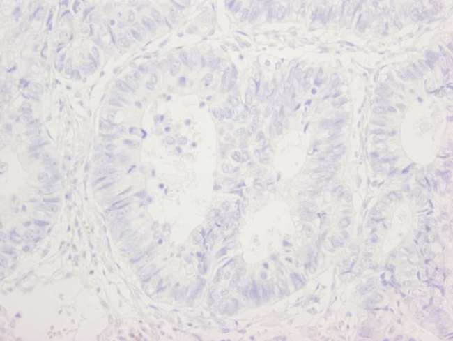 TP53BP1 / 53BP1 Antibody - Detection of Human Phospho-53BP1 (Ser 25) by Immunohistochemistry. Sample: FFPE section of human colon adenocarcinoma. Lambda and CIP phosphatase treated section immunostained for Phospho-53BP1. Antibodies: Affinity purified rabbit anti-Phospho-53BP1 (Ser 25) used at a dilution of 1:250. Detection: DAB.