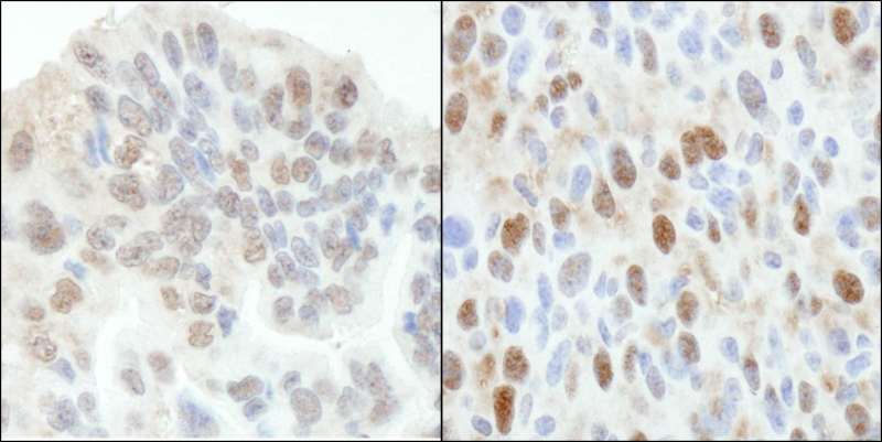 TP53BP2 / ASPP2 Antibody - Detection of Human and Mouse ASPP2 by Immunohistochemistry. Sample: FFPE section of human ovarian carcinoma (left) and mouse squamous cell carcinoma (right). Antibody: Affinity purified rabbit anti-ASPP2 used at a dilution of 1:5000 (0.2 ug/ml ) and 1:1000 (1 ug/ml).
