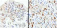 TP53BP2 / ASPP2 Antibody - Detection of Human and Mouse ASPP2 by Immunohistochemistry. Sample: FFPE section of human ovarian carcinoma (left) and mouse squamous cell carcinoma (right). Antibody: Affinity purified rabbit anti-ASPP2 used at a dilution of 1:5000 (0.2 ug/ml ) and 1:1000 (1 ug/ml).