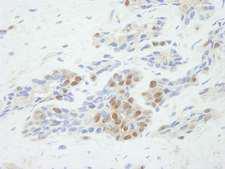 TP53BP2 / ASPP2 Antibody - Detection of Human ASPP2 by Immunohistochemistry. Sample: FFPE section of human prostate adenocarcinoma. Antibody: Affinity purified rabbit anti-ASPP2 used at a dilution of 1:500. Detection: DAB staining using anti-Rabbit IHC antibody at a dilution of 1:100.