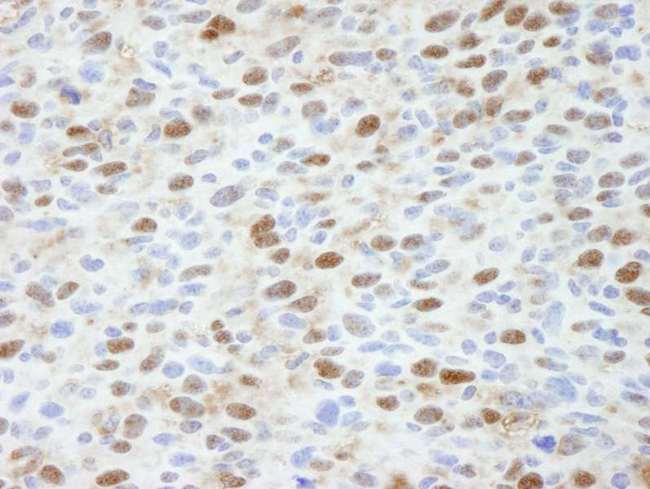 TP53BP2 / ASPP2 Antibody - Detection of Mouse ASPP2 by Immunohistochemistry. Sample: FFPE section of mouse squamous cell carcinoma. Antibody: Affinity purified rabbit anti-ASPP2 used at a dilution of 1:100. Detection: DAB staining using anti-Rabbit IHC antibody at a dilution of 1:100.