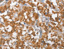 TP53BP2 / ASPP2 Antibody - Immunohistochemistry of paraffin-embedded Human thyroid cancer using TP53BP2 Polyclonal Antibody at dilution of 1:35.