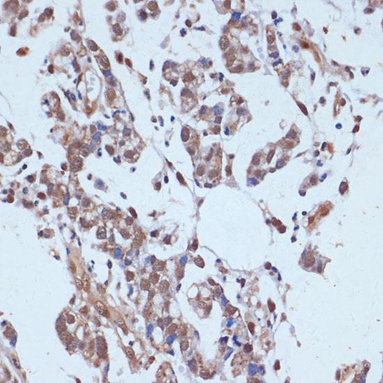 TP53BP2 / ASPP2 Antibody - Immunohistochemistry of paraffin-embedded Human gastric cancer using TP53BP2 Polyclonal Antibody at dilution of 1:100 (40x lens).
