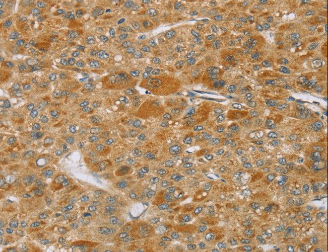 TP53I11 / PIG11 Antibody - Immunohistochemistry of paraffin-embedded Human liver cancer using TP53I11 Polyclonal Antibody at dilution of 1:40.