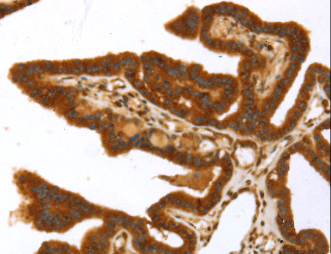 TP53I11 / PIG11 Antibody - Immunohistochemistry of paraffin-embedded Human thyroid cancer using TP53I11 Polyclonal Antibody at dilution of 1:40.