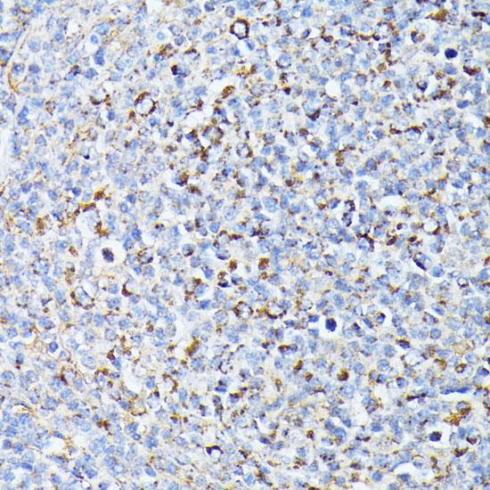 TP53I11 / PIG11 Antibody - Immunohistochemistry of paraffin-embedded Human lymph node tumors using TP53I11 Polyclonal Antibody at dilution of 1:100 (40x lens).