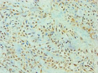 TP53I3 / PIG3 Antibody - Immunohistochemistry of paraffin-embedded human breast cancer using antibody at 1:100 dilution.