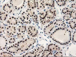TP53I3 / PIG3 Antibody - IHC of paraffin-embedded Carcinoma of Human thyroid tissue using anti-TP53I3 mouse monoclonal antibody. (Heat-induced epitope retrieval by 10mM citric buffer, pH6.0, 100C for 10min).