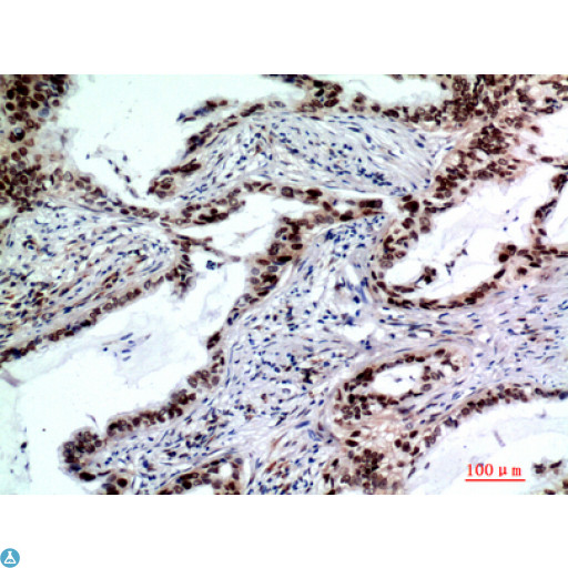 TP53INP2 Antibody - Immunohistochemistry (IHC) analysis of paraffin-embedded Human Lungcancer, antibody was diluted at 1:200.