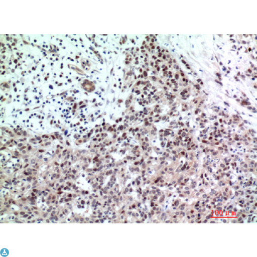 TP53INP2 Antibody - Immunohistochemistry (IHC) analysis of paraffin-embedded Human Breast Cancer, antibody was diluted at 1:200.