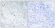 TP53INP2 Antibody - Peptide - + Immunohistochemistry analysis of paraffin-embedded human breast carcinoma tissue, using TP53INP2 antibody.