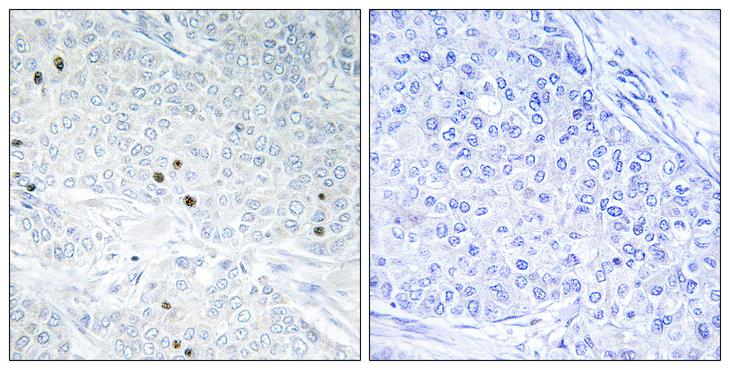 TP53INP2 Antibody - Peptide - + Immunohistochemistry analysis of paraffin-embedded human breast carcinoma tissue, using TP53INP2 antibody.