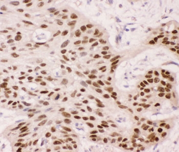 TP63 / p63 Antibody - IHC-P: p63 antibody testing of human esophagus squama cancer tissue