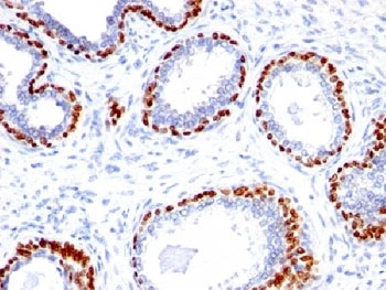 TP63 / p63 Antibody - IHC testing of FFPE human prostate cancer with p40 antibody.