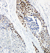 TP63 / p63 Antibody - TP63 / p63 antibody. IHC(P): Human Esophageal Squamous Cell Carcinoma Tissue.